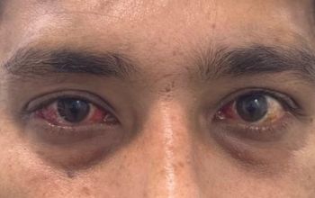 After Squint Operation 1