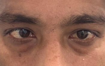 Before Squint Operation