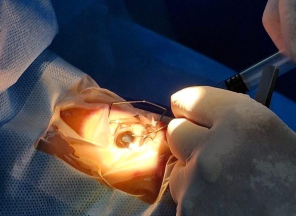 Eye Surgeries Eye Surgeries