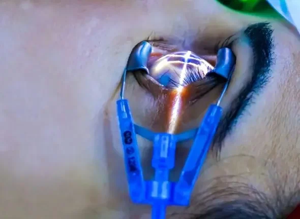 eye surgeries (1) eye surgeries (1)